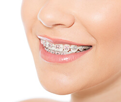 Closeup of smile with metal bracket and wire braces