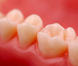 Closeup of tooth following fillings