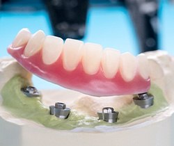 Example of implant in Coppell