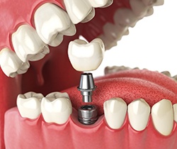3D illustration of dental implants  