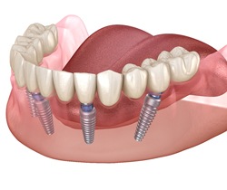 All-On-4 implants