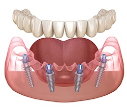 Model of All-on-4 dental implants and full dentures