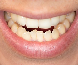 Close up of man’s crooked teeth 