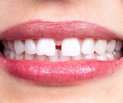 Close up of woman’s gapped teeth 