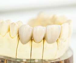 Model of dental bridge