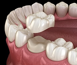 Digital illustration of a dental crown in Coppell being placed