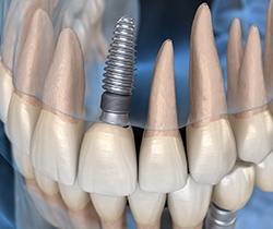 Closeup diagram of dental implant in Coppell for missing front tooth
