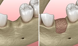 Side-by-side comparison diagram of before-and-after bone grafting in Coppell