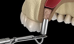 Diagram of a sinus lift in Coppell preparing for dental implants