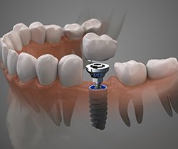 Model of single tooth dental implant in Coppell being placed