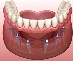 implant-retained dentures