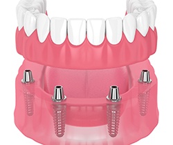illustration of implant dentures in Coppell 