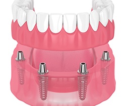 illustration of implant dentures in Coppell 