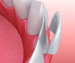 Porcelain Veneers