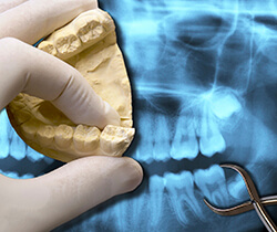 X-ray and model of wisdom teeth