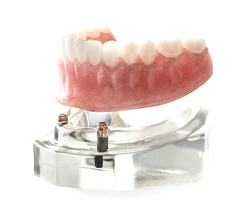 model of implant-retained dentures