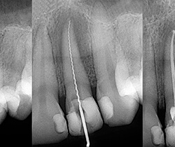 X-ray of root canal treated tooth