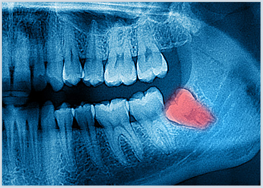 X-ray of impacted wisdom tooth