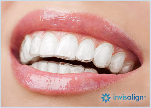 Closeup of patient wearing Invisalign aligners