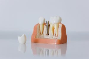 Plastic model used for dental implants in Coppell