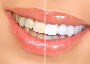 a side-by-side comparison of a whitened smile