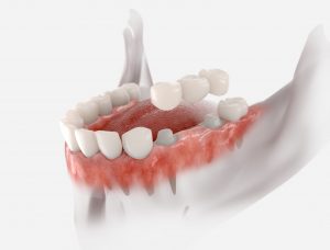 CGI of a lower jaw demonstrating how dental implant sit over abutments on a white background